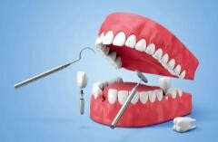 单颗种植牙修复需要多长时间？