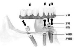 选择全口种植牙修复牙需要满足哪些条件？