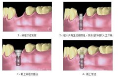 全口种植牙术前检查