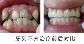 牙列不齐应对